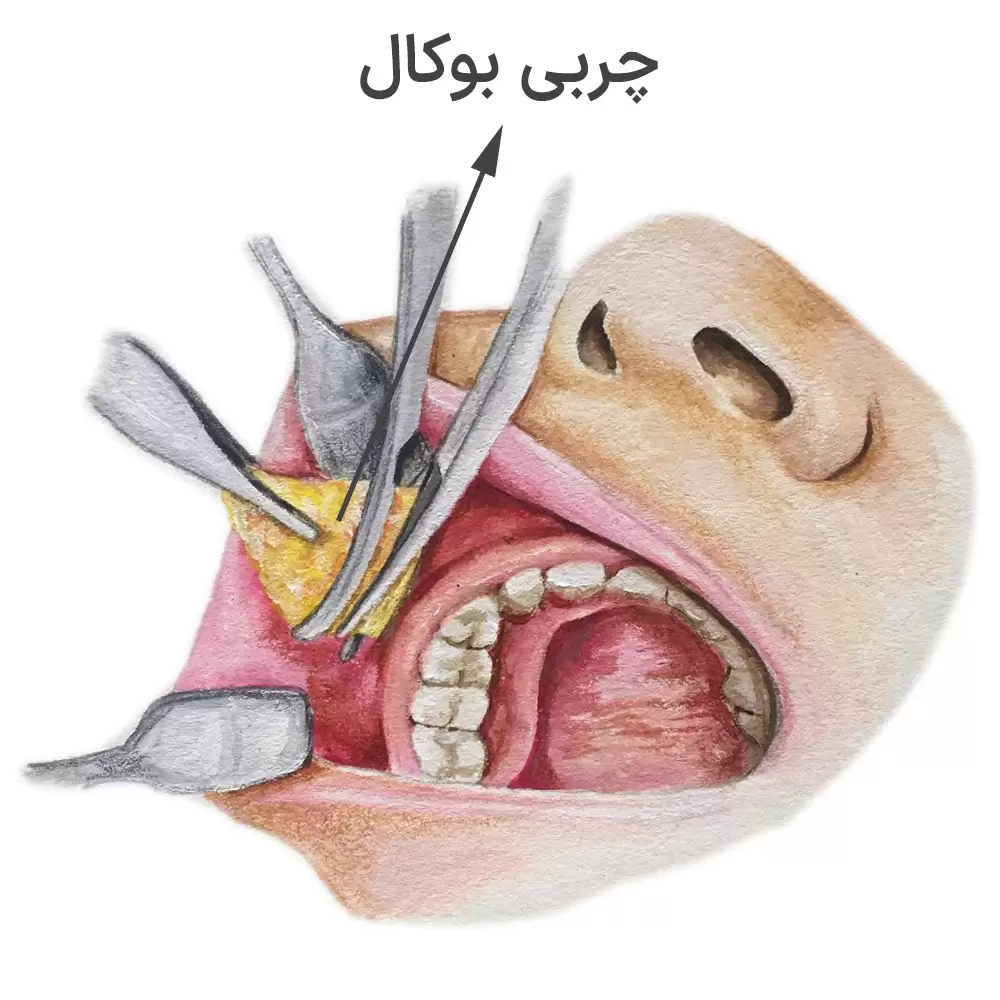 جراحی بوکال فت